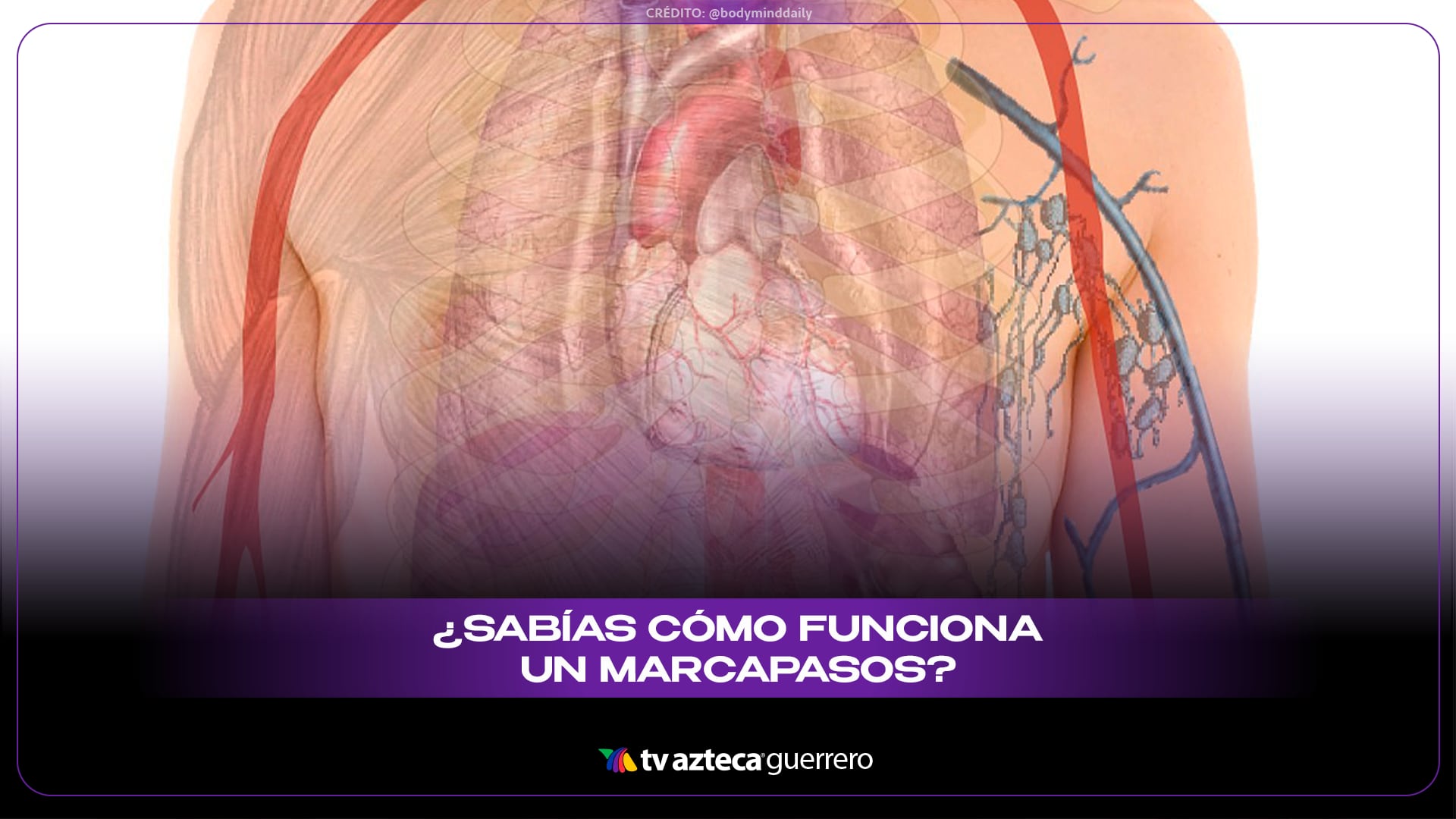 ¿Cómo funciona un marcapasos? La tecnología que regula el corazón